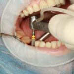 Implantes dentales