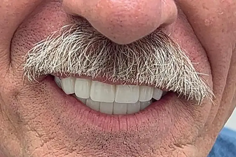 Implantes dentales con poco hueso en Buenos Aires | Dr. Salomón