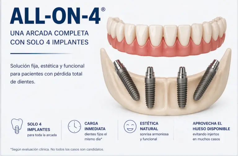 IMPLANTES DENTALES ALL ON 4