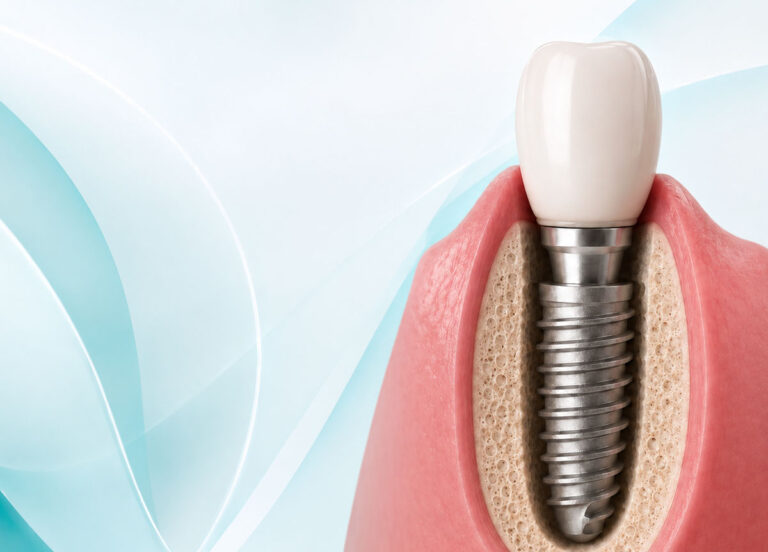 Implantes Inmediatos